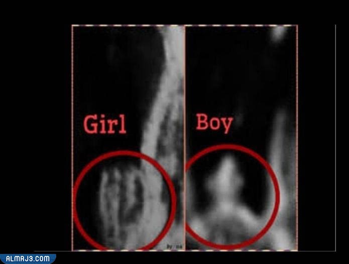 الفرق بين حمل الولد والبنت طبيًا