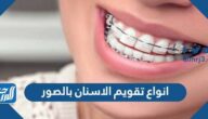 انواع تقويم الاسنان بالصور واسعارها 2025