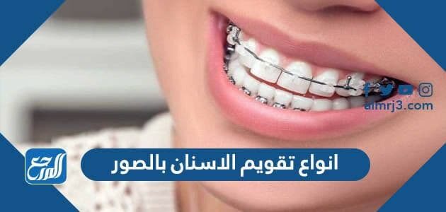 انواع تقويم الاسنان بالصور واسعارها 2026