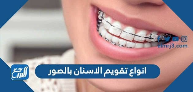 انواع تقويم الاسنان بالصور