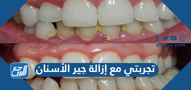 تجربتي مع إزالة جير الأسنان