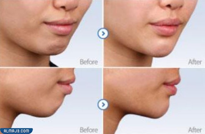 تجربتي مع جراحة الفكين