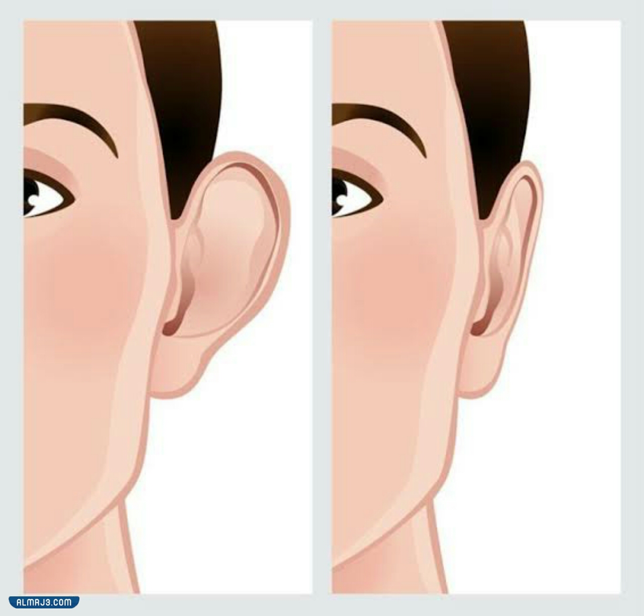 تجميل الأذن البارزة