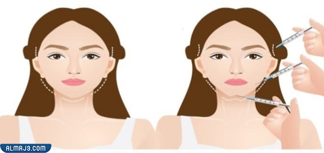 تحديد الفك بالفيلر