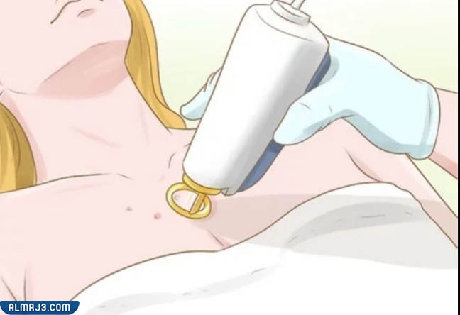 تدليك الندبة الناتجة عن عملية استئصال الثدي