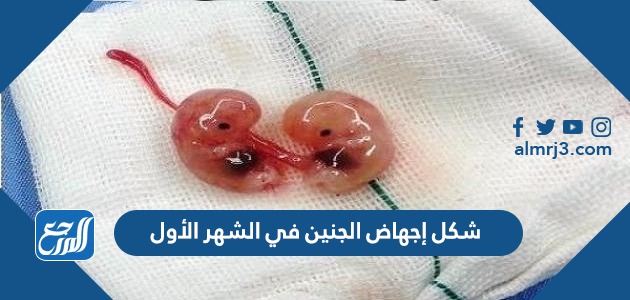 شكل إجهاض الجنين في الشهر الأول بالصور