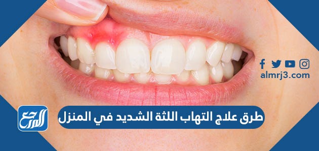 طرق علاج التهاب اللثة الشديد في المنزل