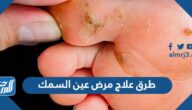 طرق علاج مرض عين السمك