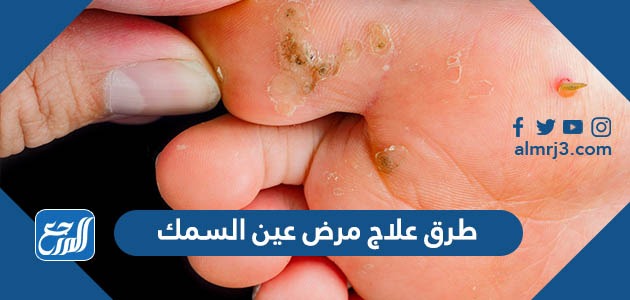 طرق علاج مرض عين السمك