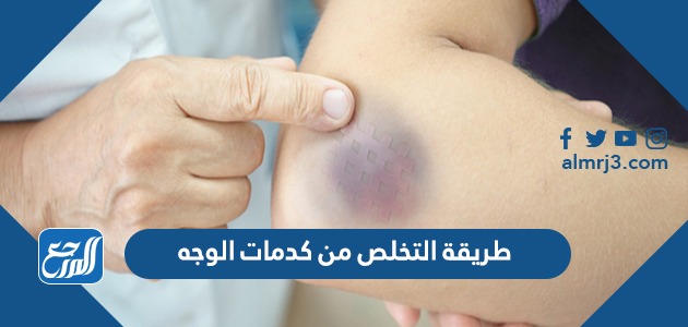 طريقة التخلص من كدمات الوجه