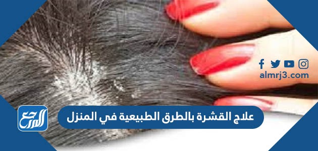 علاج القشرة بالطرق الطبيعية في المنزل