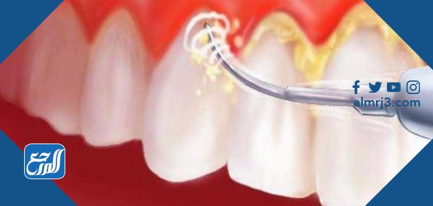 علاج جير الاسنان