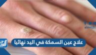 علاج عين السمكة في اليد نهائيا