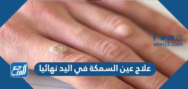 علاج عين السمكة في اليد نهائيا