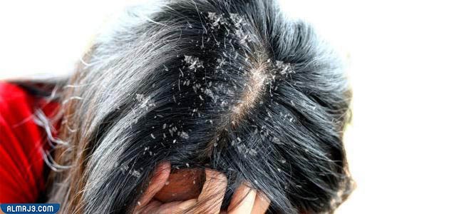 علاج فروة الرأس الدهنية بطرق بسيطة