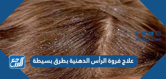 علاج فروة الرأس الدهنية بطرق بسيطة