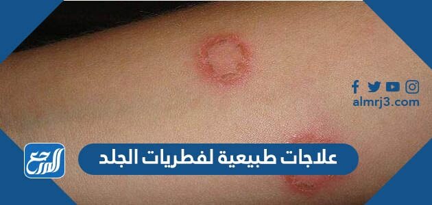 علاجات طبيعية لفطريات الجلد