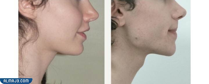 عملية الفك العلوي قبل وبعد