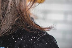 علاج القشرة بالطرق الطبيعية في المنزل