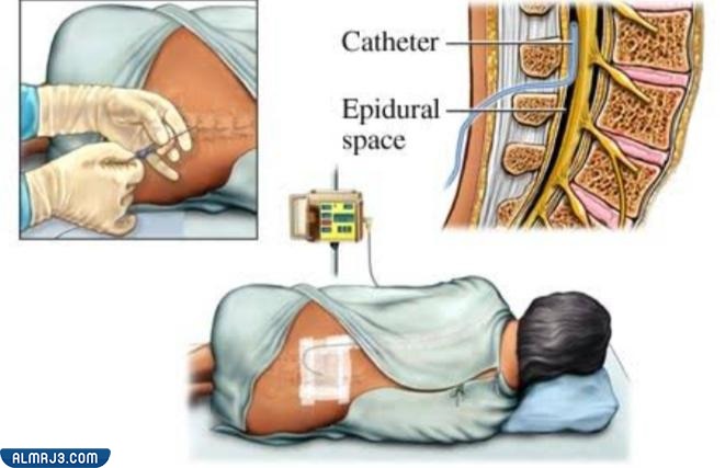 كيفية علاج الناسور العصعصي