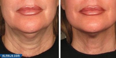 ما هو أفضل جهاز لشد اللغلوغ اللغد