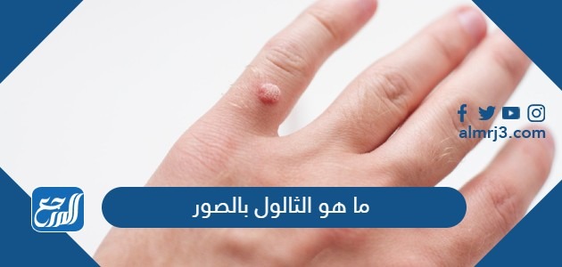 ما هو الثالول بالصور