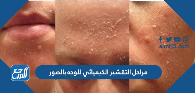 مراحل التقشير الكيميائي للوجه بالصور