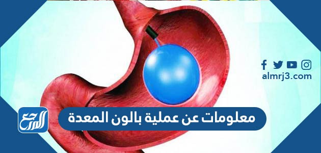 معلومات عن عملية بالون المعدة