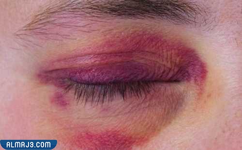 نصائح للتخلص من كدمات العين