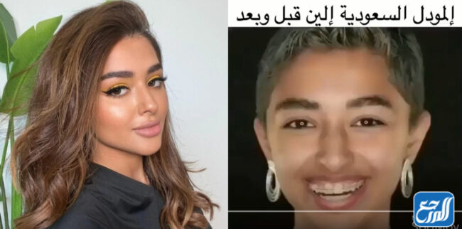 الين سليمان قبل وبعد التجميل
