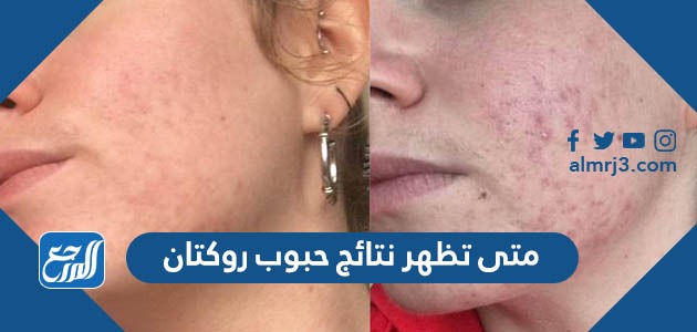 متى تظهر نتائج حبوب روكتان