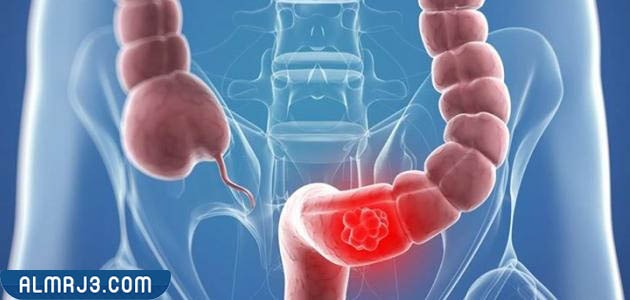 أسباب القولون التقرحي