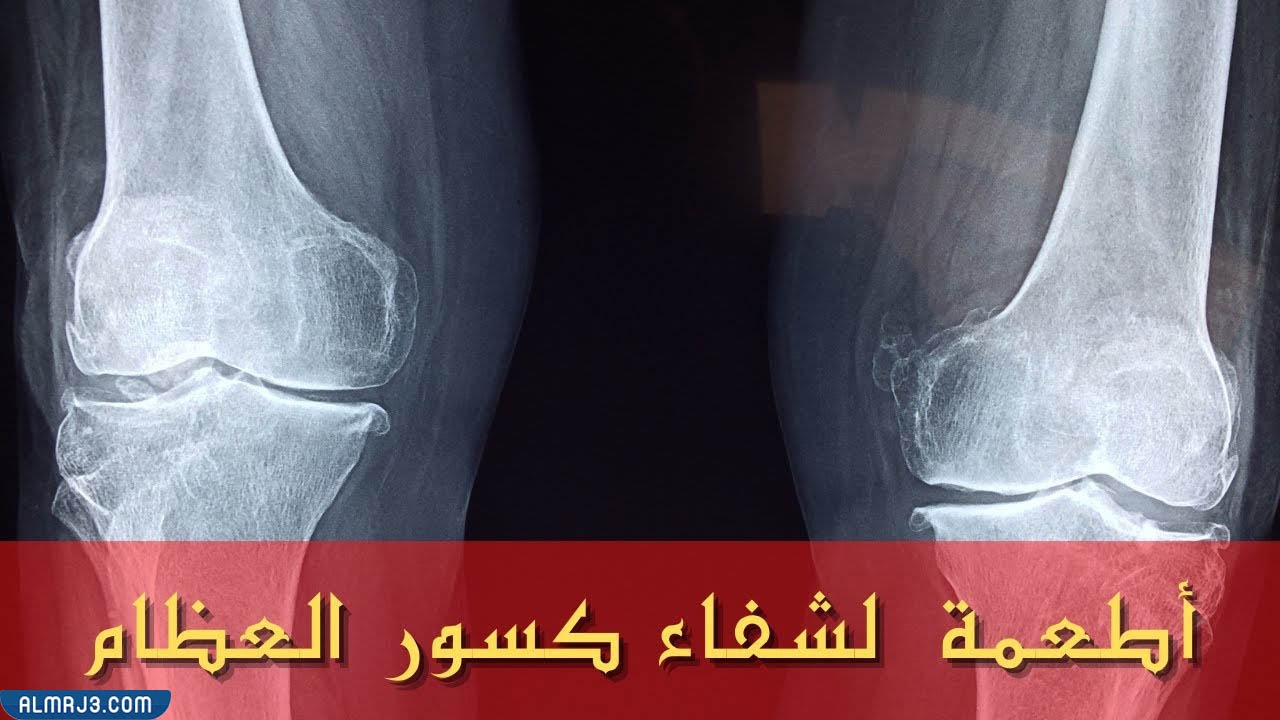 أطعمة تعجل من شفاء كسور العظام