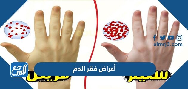 اعراض فقر الدم الحاد