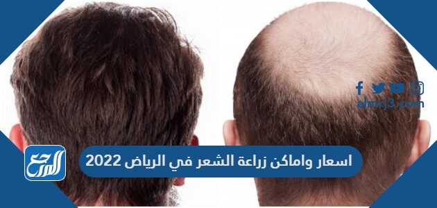 زراعة شعر الرياض