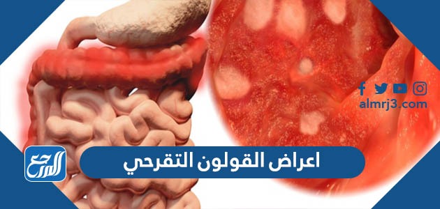 اعراض القولون التقرحي