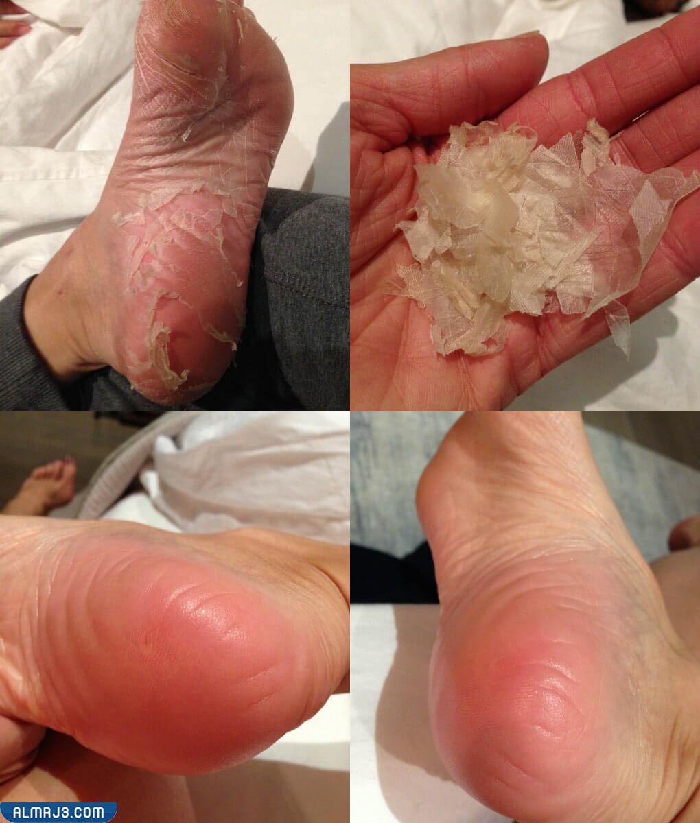 طرق إزالة الجلد الميت عن القدم