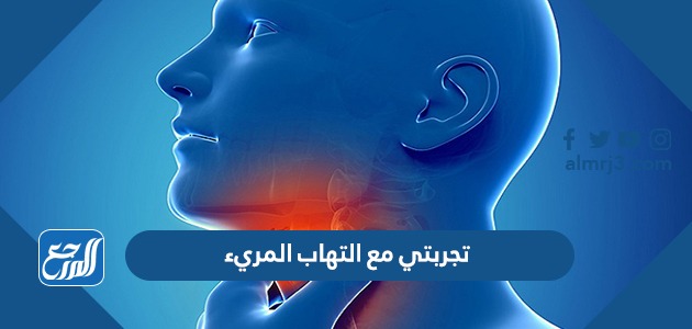 تجربتي مع التهاب المريء