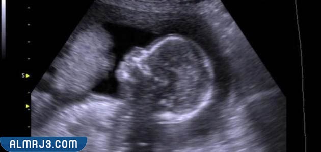 تحديد جنس الجنين بواسطة السونار
