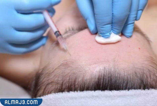 تصغير حجم الجبهة عن طريق حُقن الفيلر