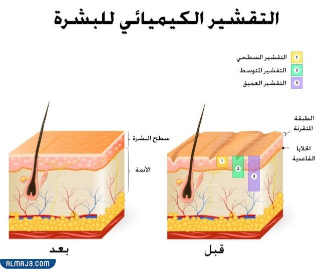 تقشير البشرة الدهنية كيميائيًا