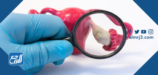 تكيس المبايض