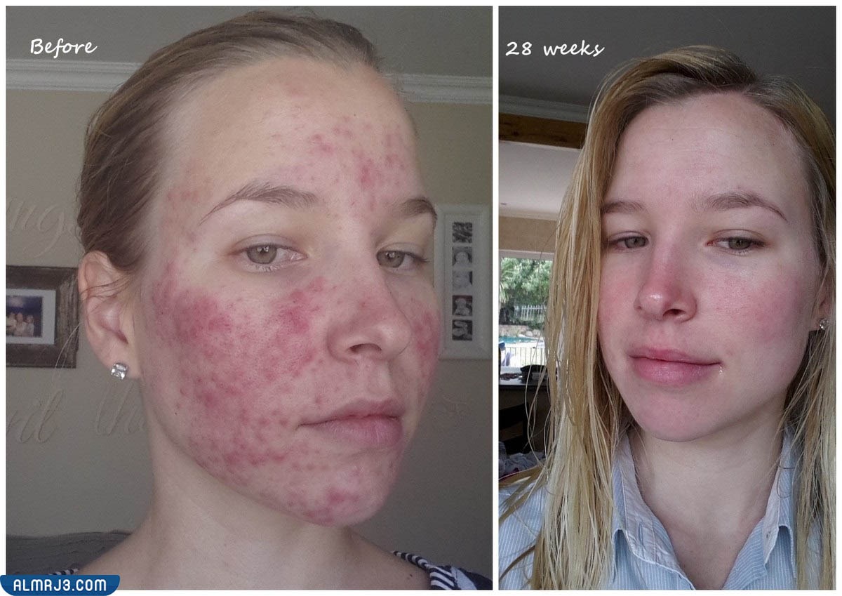 الآثار الجانبية للحبوب