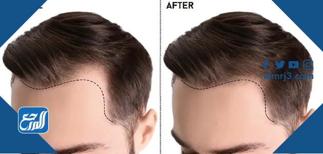 اسعار واماكن زراعة الشعر في الرياض 2022