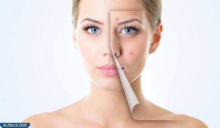 طريقة استخدام جوزة الطيب للتخلص من الحبوب والبثور