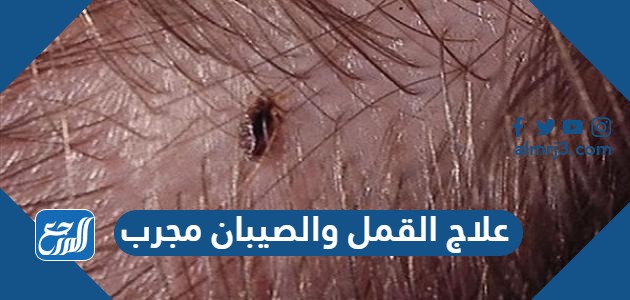 علاج القمل والصيبان مجرب