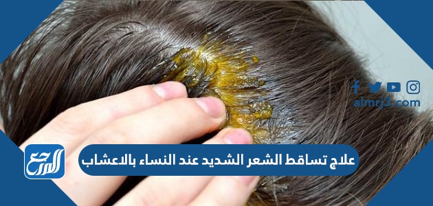 علاج تساقط الشعر الشديد عند النساء بالاعشاب