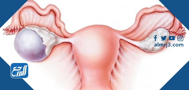 علاج تكيس المبايض