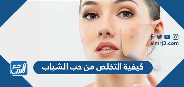 كيفية التخلص من حب الشباب نهائيا