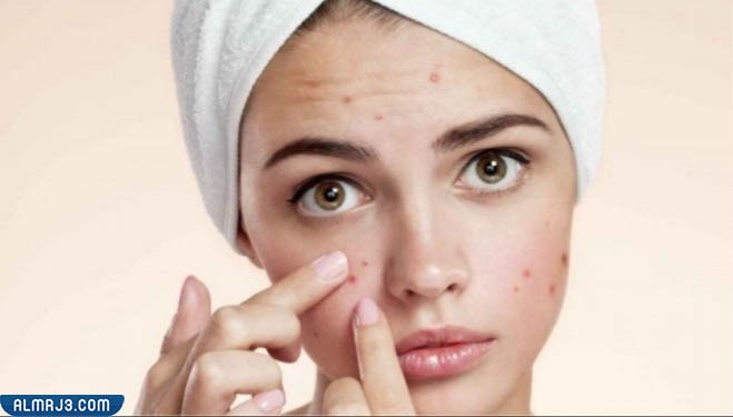 ما هي أسباب حب الشباب